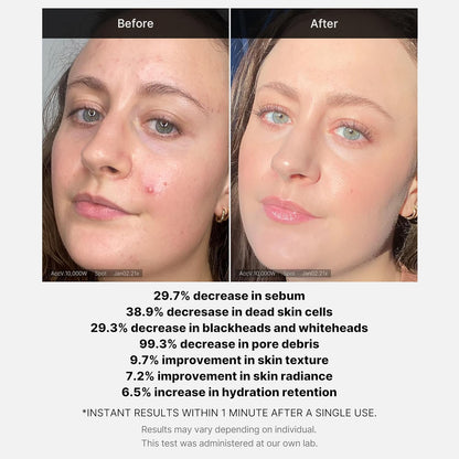 Medicube Red Acne Succinic Acid Peel - 40g