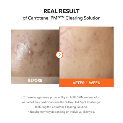 APRILSKIN Carrotene IPMP™ Clearing Solution – 0.67 fl oz / 20ml 🌿✨