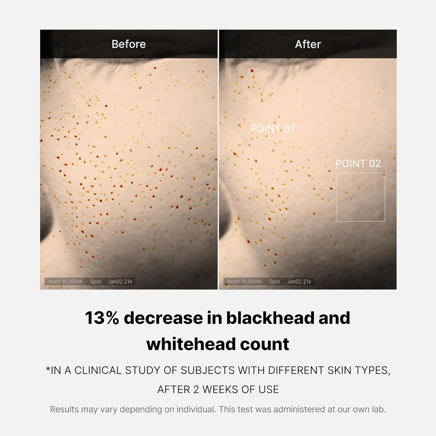 [Medicube] Zero Pore One-day Serum 30ml - Overnight Resurfacing Serum with Pore Tightening Complex - 15.2% AHA+BHA+PHA & 2% Niacinamide - 10.8% reduction in pore appearance after one day of use