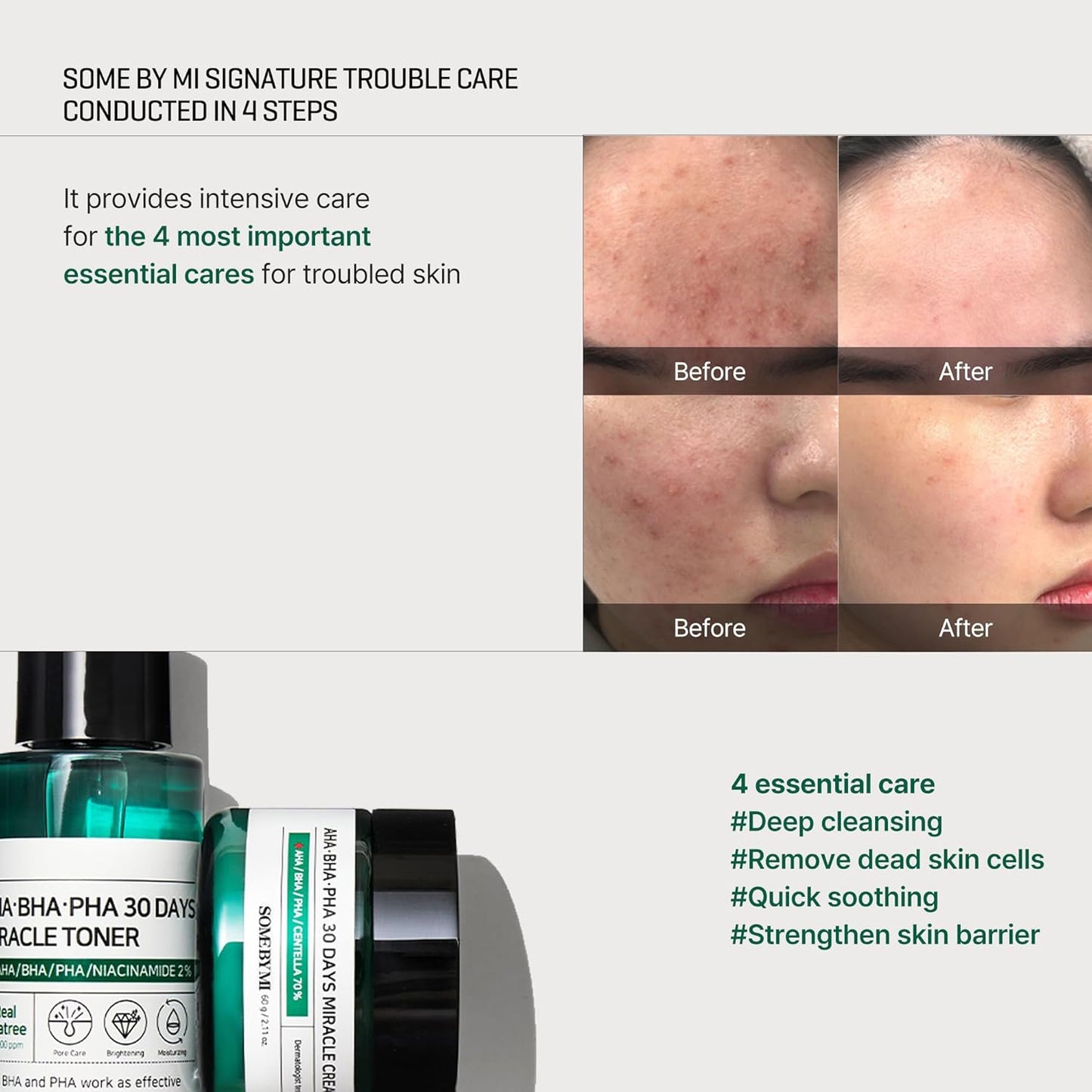 Some By Mi AHA BHA PHA 30Days Miracle AC SOS Kit