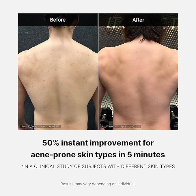 MEDICUBE Red Acne Body Wash 2.0 – Clarify & Calm Body Cleanse - 400 g